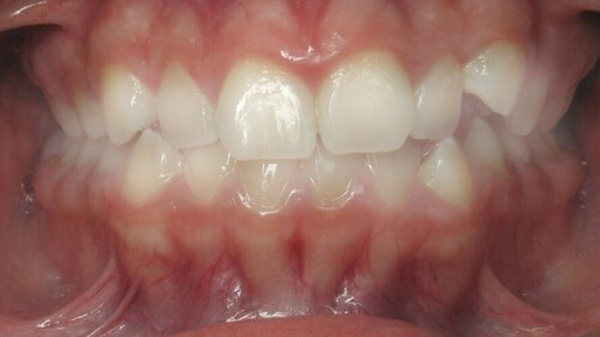 Ceramic Clear Braces Carmel IN Orthodontists