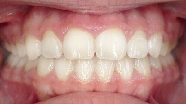 Ceramic Clear Braces Carmel Orthodontists