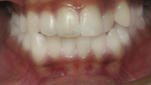 Invisalign Orthodontists Near Me