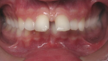 Lingual Braces Carmel IN Orthodontists