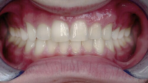 Lingual Braces Carmel Orthodontists