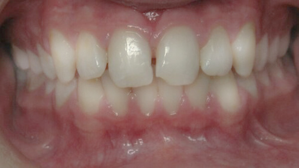 Orthodontic Retainers Carmel Indiana