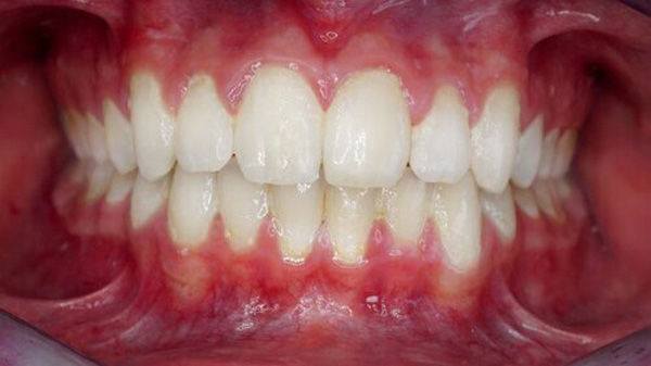 Orthodontic Retainers Carmel