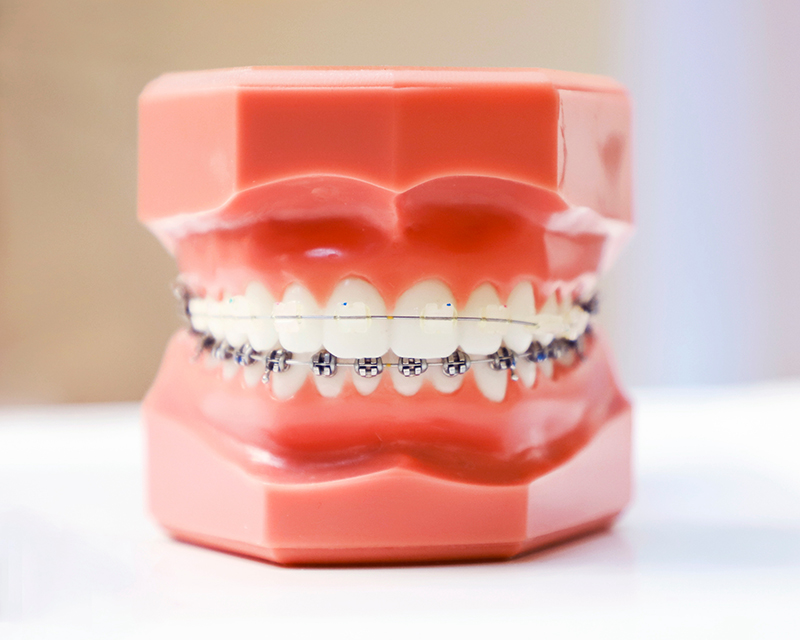 Metal braces and ceramic braces Carmel IN orthodontists