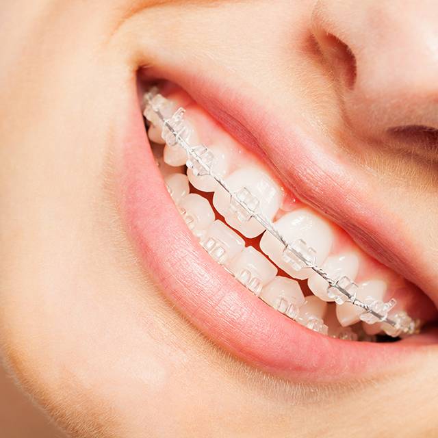 Clear ceramic braces Carmel IN orthodontists