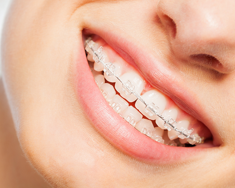 Clear ceramic braces Carmel IN orthodontists