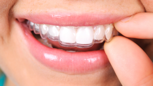 Invisalign Tips